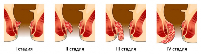 стадии гемороя