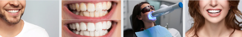 Методи відбілювання, що застосовуються в сучасній стоматології | Велика  Епоха