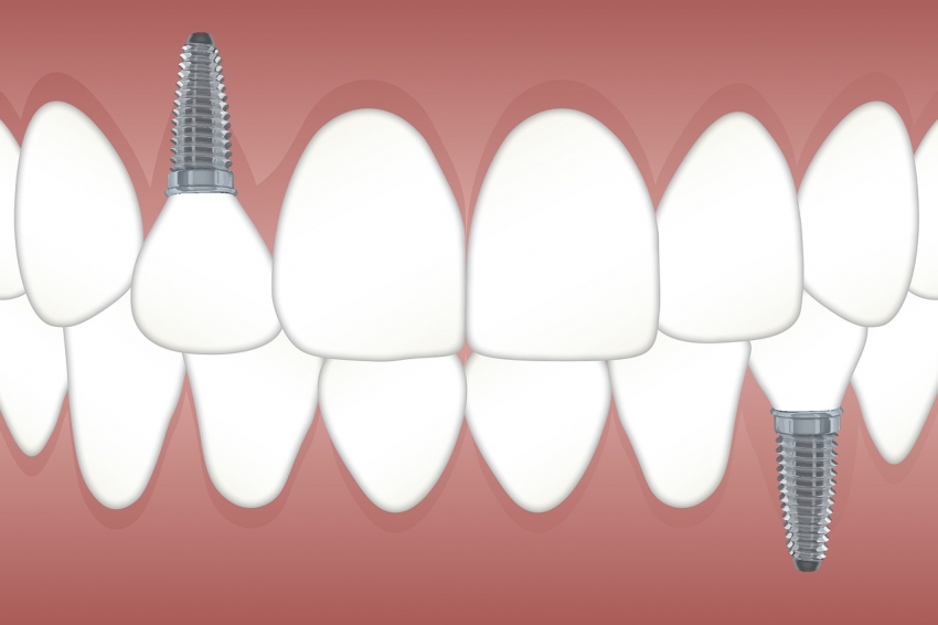  Имплантация зубов