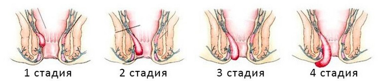 геморрой