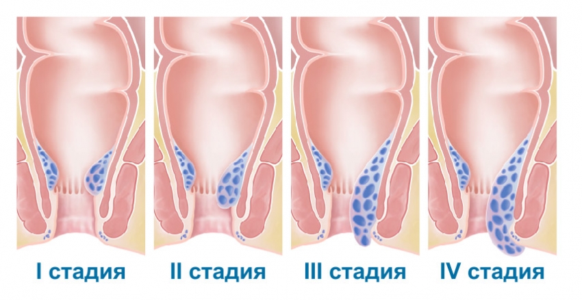 стадії геморою