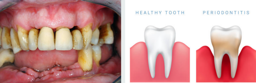 Періодонтит