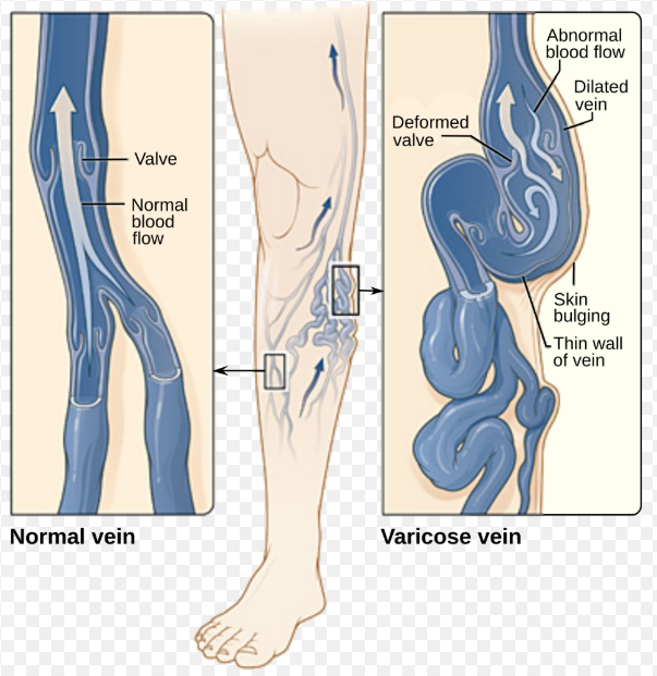 варикоз
