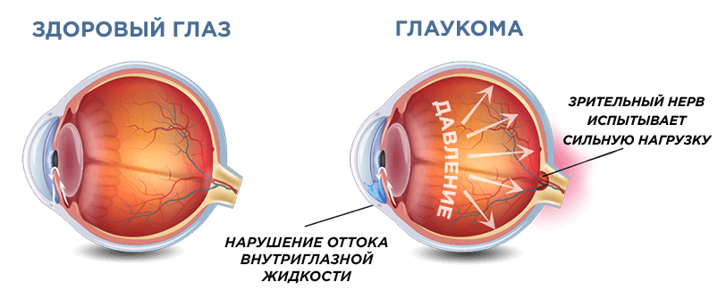 глаукома