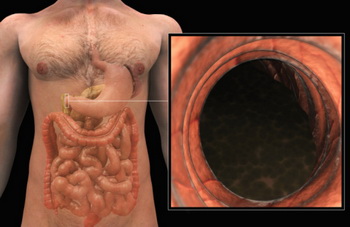 Фотографія антрального відділу шлунку, зроблена за допомогою ендоскопії. Фото: 3D4Medical.com/Getty Images News