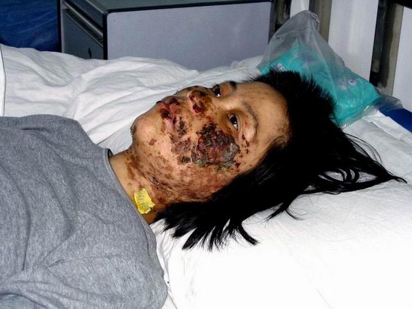 Последовательница Фалуньгун Гао Жунжун в больнице после пыток электрическими дубинками. Фото с minghui.org 