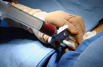 Корейський хірург завербував остеобласти. Аспірація кісткового мозку. Фото: dic.academic.ru/