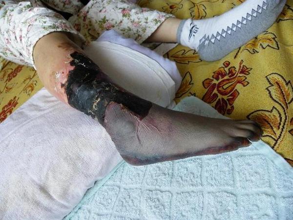 Повреждённая нога Сун Хуэйлань. Фото: minghui.org