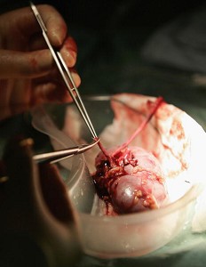 У Кореї перевірили 490 чоловік, що їздили до Китаю на операцію пересадки печінки, 32 із них були заражені гепатитом групи В і С (Christopher Furlong/Getty Images)