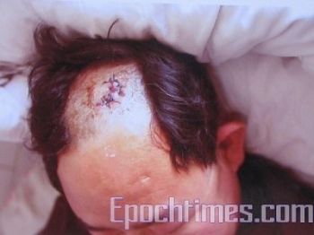 Сельский житель получил травму железной арматурой от члена преступной группировки. Фото: The Epoch Times