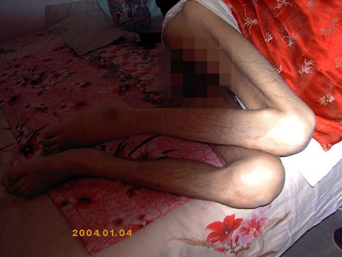 Ноги г-на Ян Сяоцзе после освобождения на поруки для прохождения лечения. Фото с minghui.org 