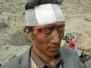 Один из тибетцев, раненых полицейскими. Фото: savetibet.ru