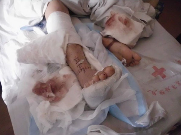 Тяжелые травмы сухожилий рук и ног рабочего. Фото: theepochtimes.com