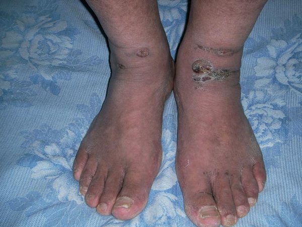 Раны на ногах последовательницы Фалуньгун Гао Кэ, оставшиеся от пытки «железный стул». Фото с minghui.org 