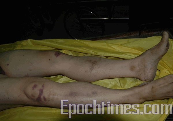 Тіло Ше Шоуляня покрите ранами та синцями. Фото: The Epoch Times 