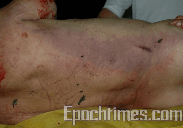 Тіло Ше Шоуляня покрите ранами та синцями. Фото: The Epoch Times 