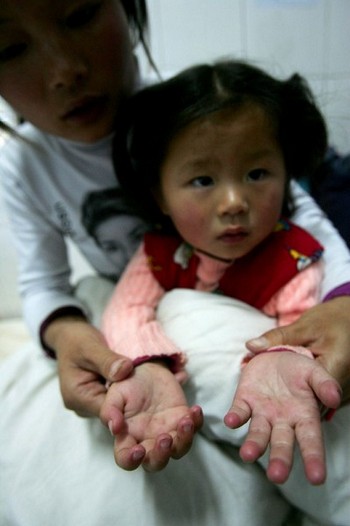 Двухлетняя девочка из провинции Аньхой заражена энтеровирусом 71. Фото: China Photos/Getty Images