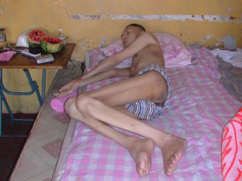 Последователь Фалуньгун У Чунлун после пыток в исправительном лагере города Цзямусы, за неделю до смерти. Фото с epochtimes.com