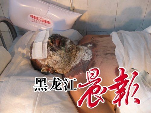 После попытки самосожжения у мужчины сильно обгорело лицо, но опасности для жизни нет. Фото с aboluowang.com 
