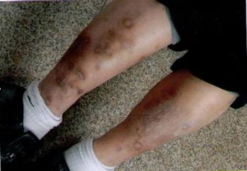 Через год на ногах Лан Сяньго всё ещё отчётливо видны следы от пытки. Фото с epochtimes.com 
