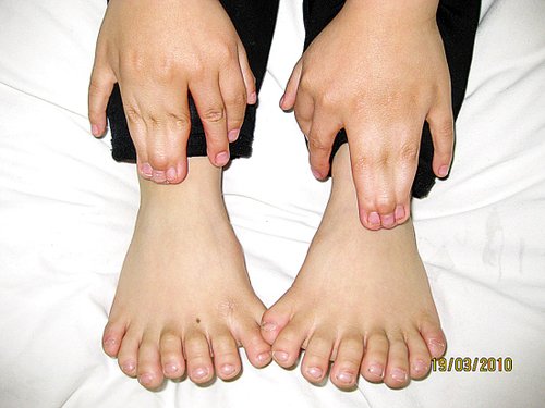 У шестирічного жителя міста Харбіна провінції Хейлунцзян 15 пальців на руках і 16 на ногах. Фото з epochtimes.com 