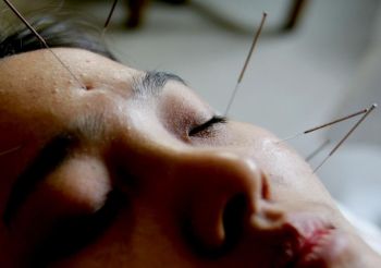 Иглоукалывание - важная часть китайской медицины. Фото: China Photos /Getty Images