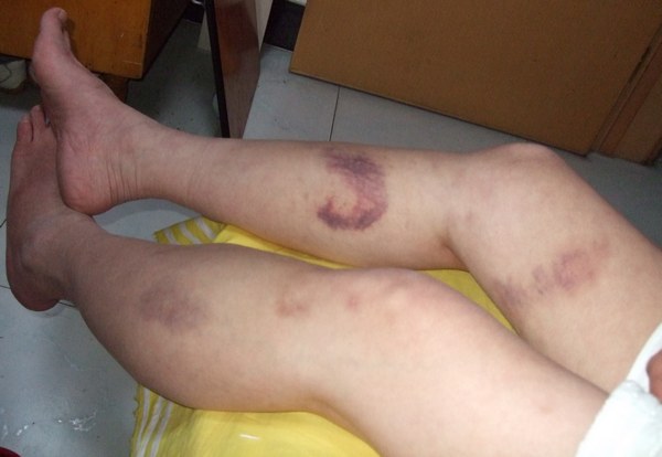 Раны на ногах г-жи Чжан Ляньин, полученные в результате избиений в трудовом лагере. Фото с minghui.org