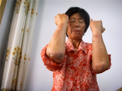 Ожоги от пыток на руках г-жи Сан Чунлянь после заключения в полицейском участке. Фото с epochtimes.com 