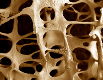 Остеопороз возникает в связи с уменьшением плотности и потерей костными структурами прочности за счет вымывания из них кальция. Фото: Alan Boyde/Getty Images