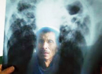 У Китаській Народній Республіці від запилення легенів щороку помирає шість тисяч шахтарів. Фото: news.aweb.com.cn