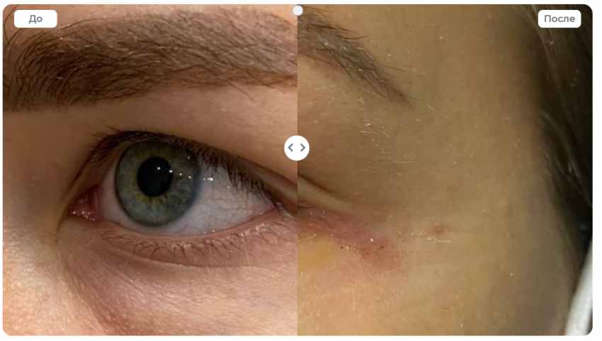 Липофилинг