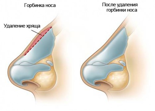 пластика носа