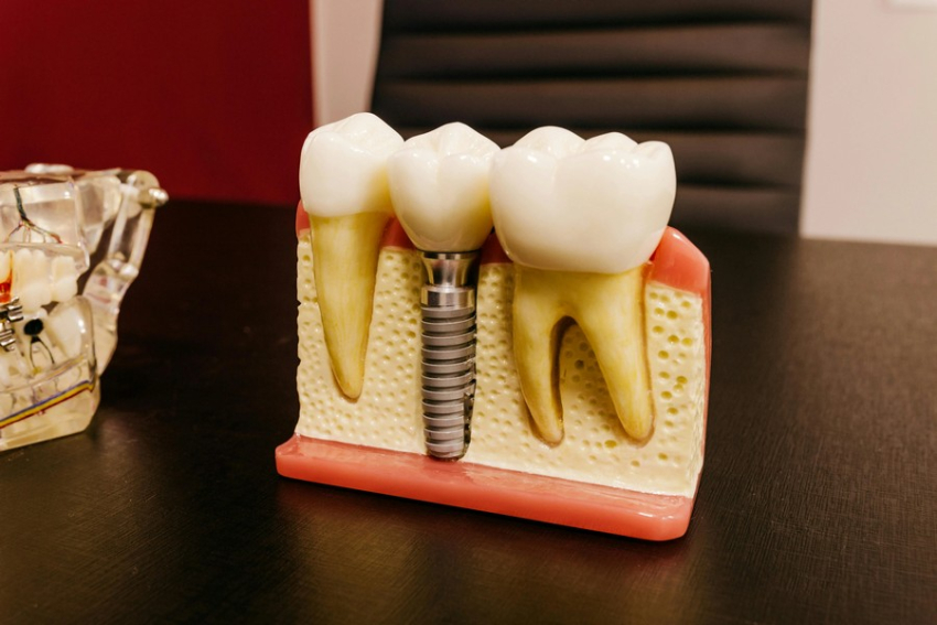 Джерело: healthydent.ua