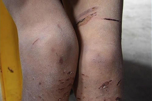 На ногах Дин Дин раны от жестоких наказаний, применяемых родителями. Фото с epochtimes.com