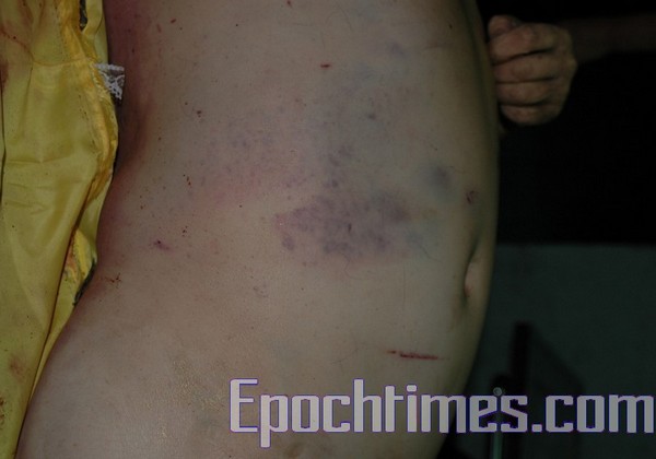 Тело Шэ Шоуляня покрытое ранами и синяками. Фото: The Epoch Times