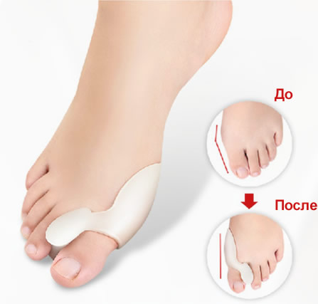 Valgus Pro — новый и эффективный способ борьбы с шишкой на ноге. Фото: m.valguspro.com