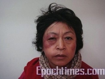 Шанхайская апеллянтка Ши Жуйсинь после избиения представителями властей. Фото: The Epoch Times