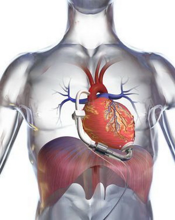 Схематическое изображение нового искусственного сердца. Фото: DeBakey Heart Assist/Micromed