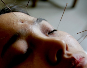 Акупунктура традиционной китайской медицины доказала свою действенность при лечении головных болей. Фото: China Photos / Getty Images