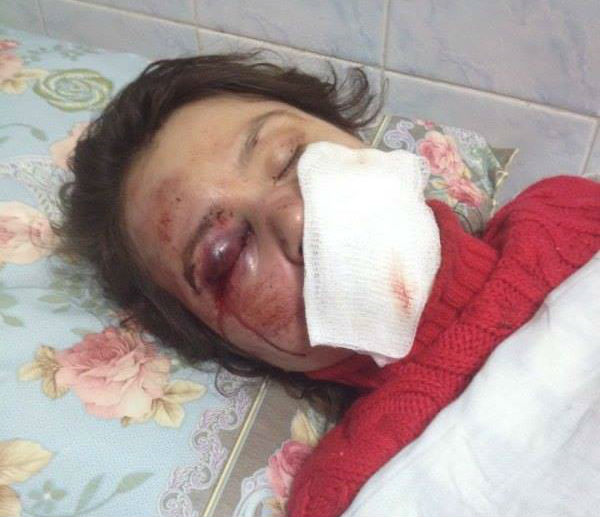 Татьяна Черновол была жестоко избита неизвестными. Фото: ШТУРМ Банковой/facebook.com
