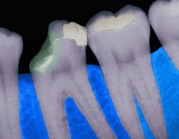 Причиной кариеса является бактерия Bifidobacterium dentium, относящаяся к бифидобактериям. Фото: Фото: Gerald & Buff Corsi/Getty Images