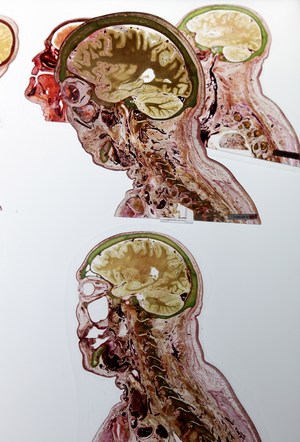 Инсульт — острое нарушение мозгового кровообращения, возникающее в результате закупорки, спазма или разрыва хрупких сосудов головного мозга. Фото: Sean Gallup/Getty Images