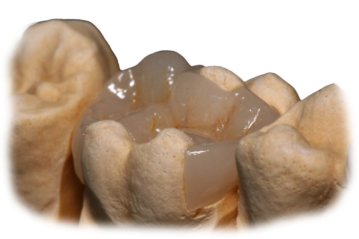 керамическая вкладка на зуб
