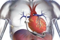 Схематическое изображение нового искусственного сердца. Фото: DeBakey Heart Assist/Micromed