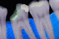 Причиной кариеса является бактерия Bifidobacterium dentium, относящаяся к бифидобактериям. Фото: Фото: Gerald & Buff Corsi/Getty Images