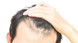 Пересадка волос методом FUE: как вернуть красивую шевелюру?
