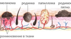 Лазерное удаление папиллом