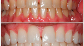 Magic Smile: почему стоит отбеливать зубы по этой технологии?