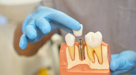 Імплантація після втрати зуба: чому важливо не затягувати з вирішенням проблеми