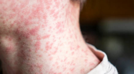 Великобританія та низка інших держав втратили статус країн, що ліквідували кір